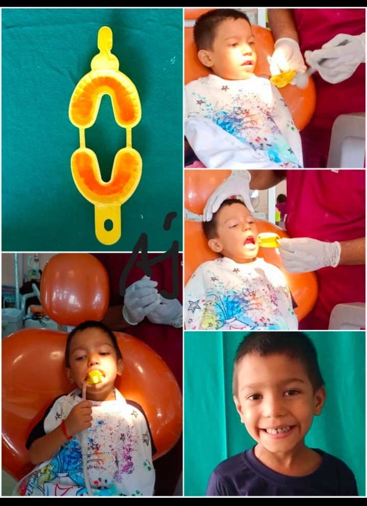 Fluoride treatment for kids